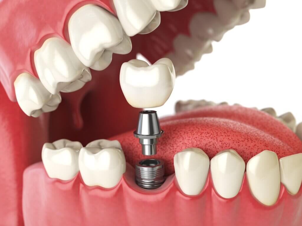 dental-implants-in-hyderabad