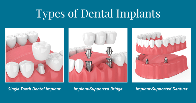 implant-dentistry-types