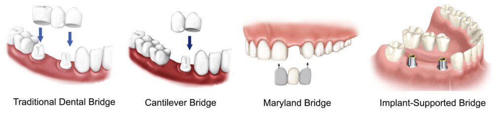 types-of-dental-bridges